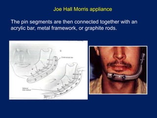 Joe Hall Morris appliance
The pin segments are then connected together with an
acrylic bar, metal framework, or graphite rods.
 