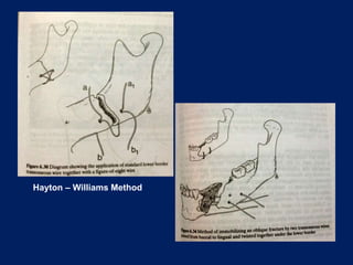 Hayton – Williams Method
 