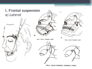 l. Frontal suspension
a) Lateral
 