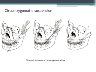 Circumzygomatic suspension
 