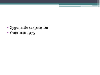 • Zygomatic suspension
• Guerman 1975
 