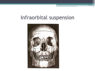Infraorbital suspension
 