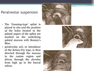 Peralveolar suspension
• The 'Gunning-type' splint is
placed in situ and the position
of the holes located in the
palatal aspect of the splint are
marked on the underlying
palatal mucosa with Bonney's
Blue.
• peralveolar awl, or introducer
of the Kelsey-Fry type, is then
directed through the mucosa
in the canine region and
driven through the alveolus
from high up in the buccal
sulcus.
 