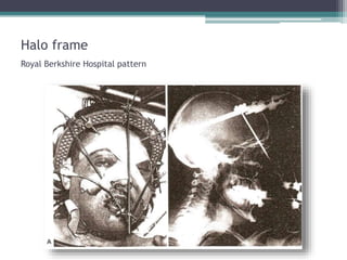 Royal Berkshire Hospital pattern
Halo frame
 