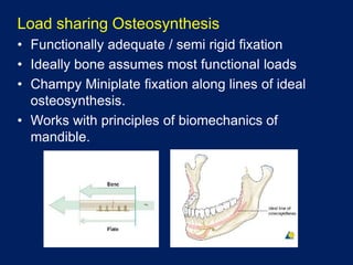 Load sharing Osteosynthesis
• Functionally adequate / semi rigid fixation
• Ideally bone assumes most functional loads
• Champy Miniplate fixation along lines of ideal
osteosynthesis.
• Works with principles of biomechanics of
mandible.
 