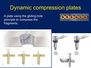 Dynamic compression plates
A plate using the gliding-hole
principle to compress the
fragments.
 