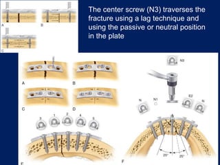 The center screw (N3) traverses the
fracture using a lag technique and
using the passive or neutral position
in the plate
 