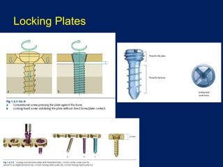 Locking Plates
 
