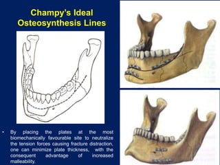 Champy’s Ideal
Osteosynthesis Lines
• By placing the plates at the most
biomechanically favourable site to neutralize
the tension forces causing fracture distraction,
one can minimize plate thickness, with the
consequent advantage of increased
malleability.
 
