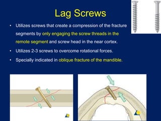 Lag Screws
• Utilizes screws that create a compression of the fracture
segments by only engaging the screw threads in the
remote segment and screw head in the near cortex.
• Utilizes 2-3 screws to overcome rotational forces.
• Specially indicated in oblique fracture of the mandible.
 