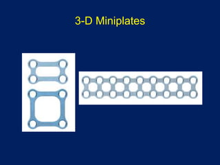 3-D Miniplates
 