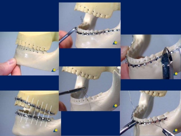 Metallurgy & fixation methods 4 wire hitch wiring 