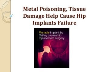 Metal Poisoning, Tissue
Damage Help Cause Hip
   Implants Failure
 