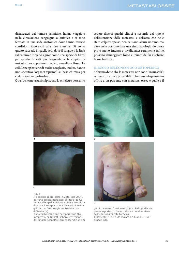 Metastasi Ossee Skeletal Metastases