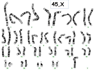 45,X
 