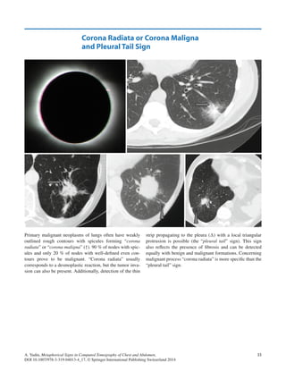 Metaphorical signs in computed tomography of chest and abdomen 2014 | PDF