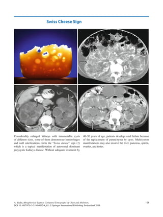 Metaphorical signs in computed tomography of chest and abdomen 2014 | PDF