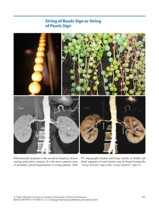 Metaphorical signs in computed tomography of chest and abdomen 2014 | PDF