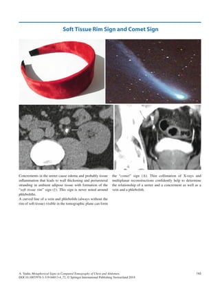 Metaphorical signs in computed tomography of chest and abdomen 2014 | PDF