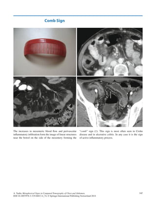 Metaphorical signs in computed tomography of chest and abdomen 2014 | PDF