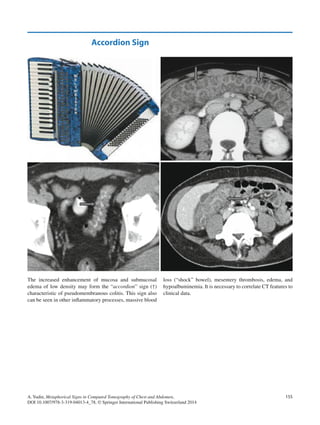 Metaphorical signs in computed tomography of chest and abdomen 2014 | PDF