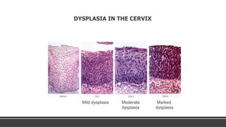 metaplasia PATHOLOGY BY TALHA SHAHID.pptx