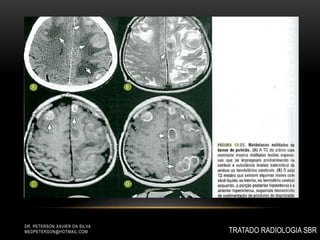 TRATADO RADIOLOGIA SBR
DR. PETERSON XAVIER DA SILVA
MEDPETERSON@HOTMAIL.COM
 
