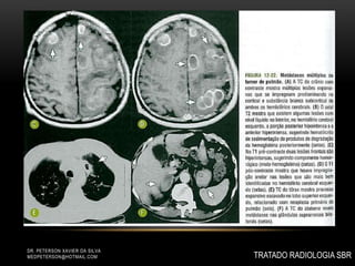 DR. PETERSON XAVIER DA SILVA
MEDPETERSON@HOTMAIL.COM TRATADO RADIOLOGIA SBR
 