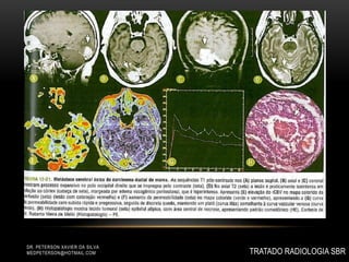 DR. PETERSON XAVIER DA SILVA
MEDPETERSON@HOTMAIL.COM TRATADO RADIOLOGIA SBR
 