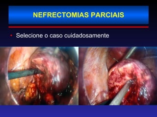 NEFRECTOMIAS PARCIAIS Selecione o caso cuidadosamente 