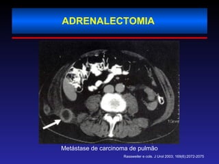 ADRENALECTOMIA  Metástase de carcinoma de pulmão Rassweiler e cols. J Urol 2003; 169(6):2072-2075 