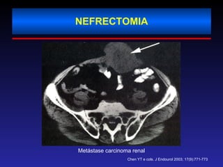 NEFRECTOMIA Metástase carcinoma renal Chen YT e cols. J Endourol 2003; 17(9):771-773 