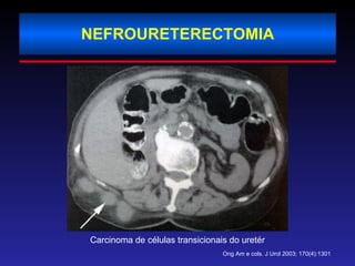 NEFROURETERECTOMIA Carcinoma de células transicionais do uretér Ong Am e cols. J Urol 2003; 170(4):1301 