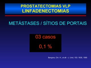 PROSTATECTOMIAS VLP LINFADENECTOMIAS   METÁSTASES / SÍTIOS DE PORTAIS 03 casos 0,1 % Bangma, Chr. H., et all – J. Urol, 153: 1635, 1995 