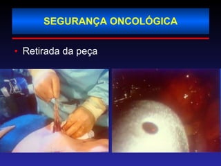 SEGURANÇA ONCOLÓGICA Retirada da peça 