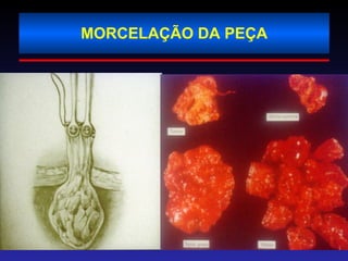MORCELAÇÃO DA PEÇA 