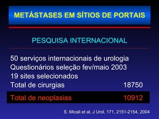 METÁSTASES EM SÍTIOS DE PORTAIS PESQUISA INTERNACIONAL 50 serviços internacionais de urologia Questionários seleção fev/maio 2003 19 sites selecionados Total de cirurgias  18750 Total de neoplasias  10912 S. Micali et al, J Urol, 171, 2151-2154, 2004 