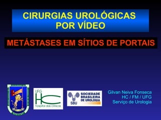 CIRURGIAS UROLÓGICAS  POR VÍDEO METÁSTASES EM SÍTIOS DE PORTAIS Gilvan Neiva Fonseca HC / FM / UFG Serviço de Urologia 