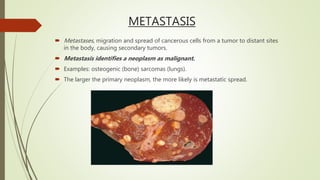 METASTASIS
 Metastases, migration and spread of cancerous cells from a tumor to distant sites
in the body, causing secondary tumors.
 Metastasis identifies a neoplasm as malignant.
 Examples: osteogenic (bone) sarcomas (lungs).
 The larger the primary neoplasm, the more likely is metastatic spread.
 