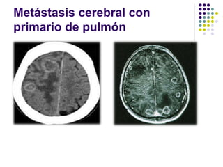 Metástasis cerebral con
primario de pulmón
 