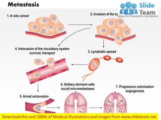 Metastasis
1. In situ cancer 2. Invasion of the tumour border
3. Lymphatic spread
4. Intravasion of the circulatory system
survival, transport
5. Arrest extravasion
6. Solitary dormant cells
occult micrometastases
7. Progressive colonization
angiogenesis
 