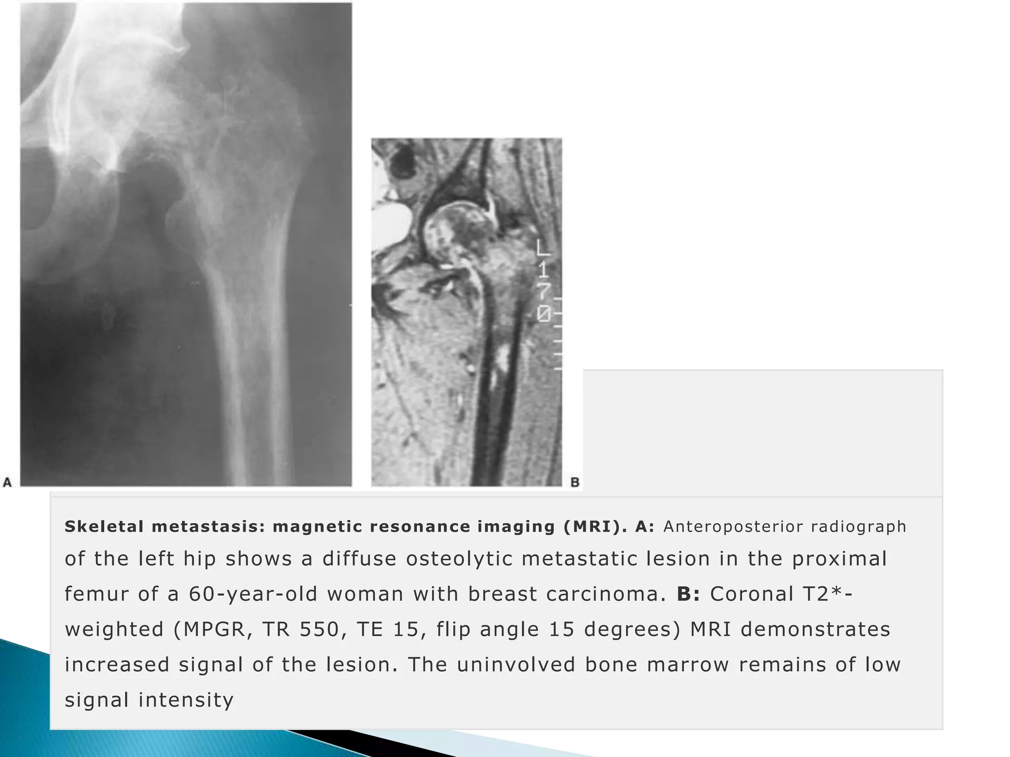 Metastatic bone disease | PPTX