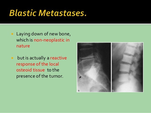 Metastatic bone tumours