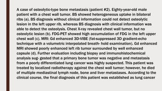 A case of osteolytic-type bone metastasis (patient #2). Eighty-year-old male
patient with a chest wall tumor. BS showed heterogeneous uptake in bilateral
ribs (a). BS diagnosis without clinical information could not detect osteolytic
lesion in the left upper rib, whereas BS diagnosis with clinical information was
able to detect the osteolysis. Chest X-ray revealed chest wall tumor, but no
osteolytic lesion (b). FDG-PET showed high accumulation of FDG in the left upper
chest wall (c). MRI: Gd enhanced 3D-VIBE (fat-suppressed 3D gradient-echo
technique with a volumetric interpolated breath- hold examination). Gd enhanced
MRI showed poorly enhanced left rib tumor surrounded by well enhanced
capsule (d). Further evaluation including biopsy and immunohistochemical
analysis sug- gested that a primary bone tumor was negative and metastasis
from a poorly differentiated lung cancer was highly suspected. This patient was
treated by localized radiotherapy against the chest wall tumor; however, he died
of multiple mediastinal lymph node, bone and liver metastases. According to the
clinical course, the final diagnosis of this patient was established as lung cancer
 