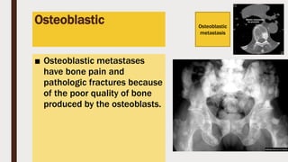 Osteoblastic
■ Osteoblastic metastases
have bone pain and
pathologic fractures because
of the poor quality of bone
produced by the osteoblasts.
Osteoblastic
metastasis
 