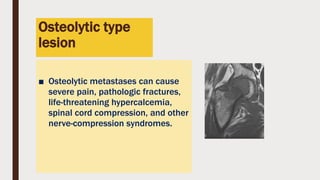 Osteolytic type
lesion
■ Osteolytic metastases can cause
severe pain, pathologic fractures,
life-threatening hypercalcemia,
spinal cord compression, and other
nerve-compression syndromes.
 