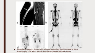 ■ Metastatic lesion rt femur with primary lesion in rt lung revealed in bone
scintigraphy,CT& MRI.( for full description please see next slide)
 