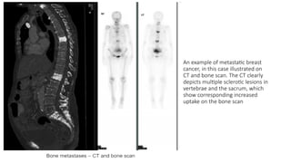 metastaticbreastcancer-200622051104 [Autosaved].pptx