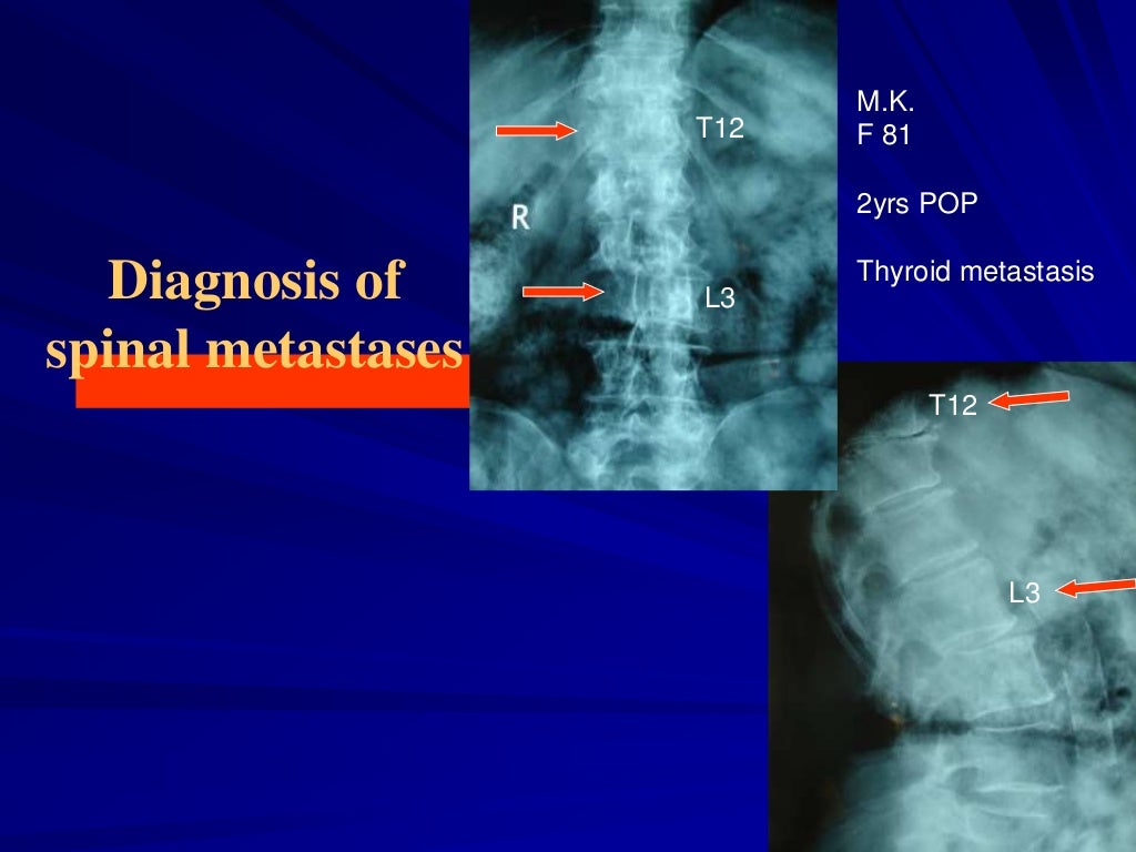 Metastatic Tumors of the Spinal Column