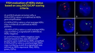FISH evaluation of HER2 status
based on 2013 ASCO/CAP scoring
criteria.
 